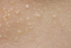 A close up of the skin on a person 's face