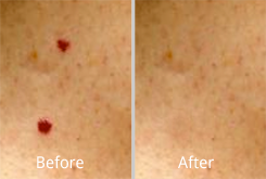 A before and after picture of the skin with red spots.