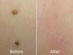 A before and after picture of the skin on a person 's back.