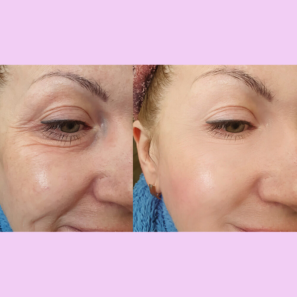 A woman with wrinkles on her face and eye lid.